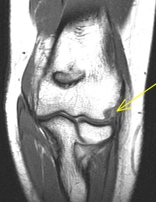 Figure 6 for case Tear of combined origin of the lateral ulnar collateral ligament and radial collateral of elbow (RID2043)(RID2035)